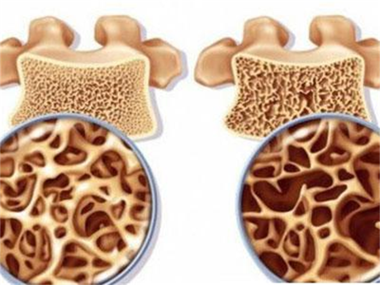 骨质疏松症，你真的了解吗？